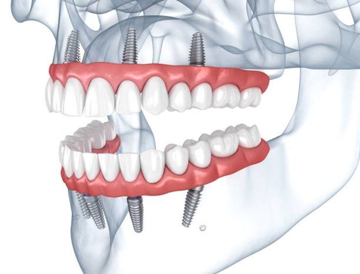 A computer generated image of a person's teeth with dental implants.