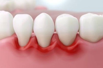 A close up of a model of a person 's teeth with a red gums.