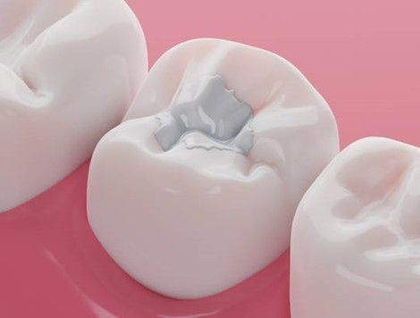 A close up of a tooth with a filling in it on a pink surface.