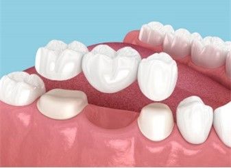 A close up of a person 's teeth with a dental bridge.