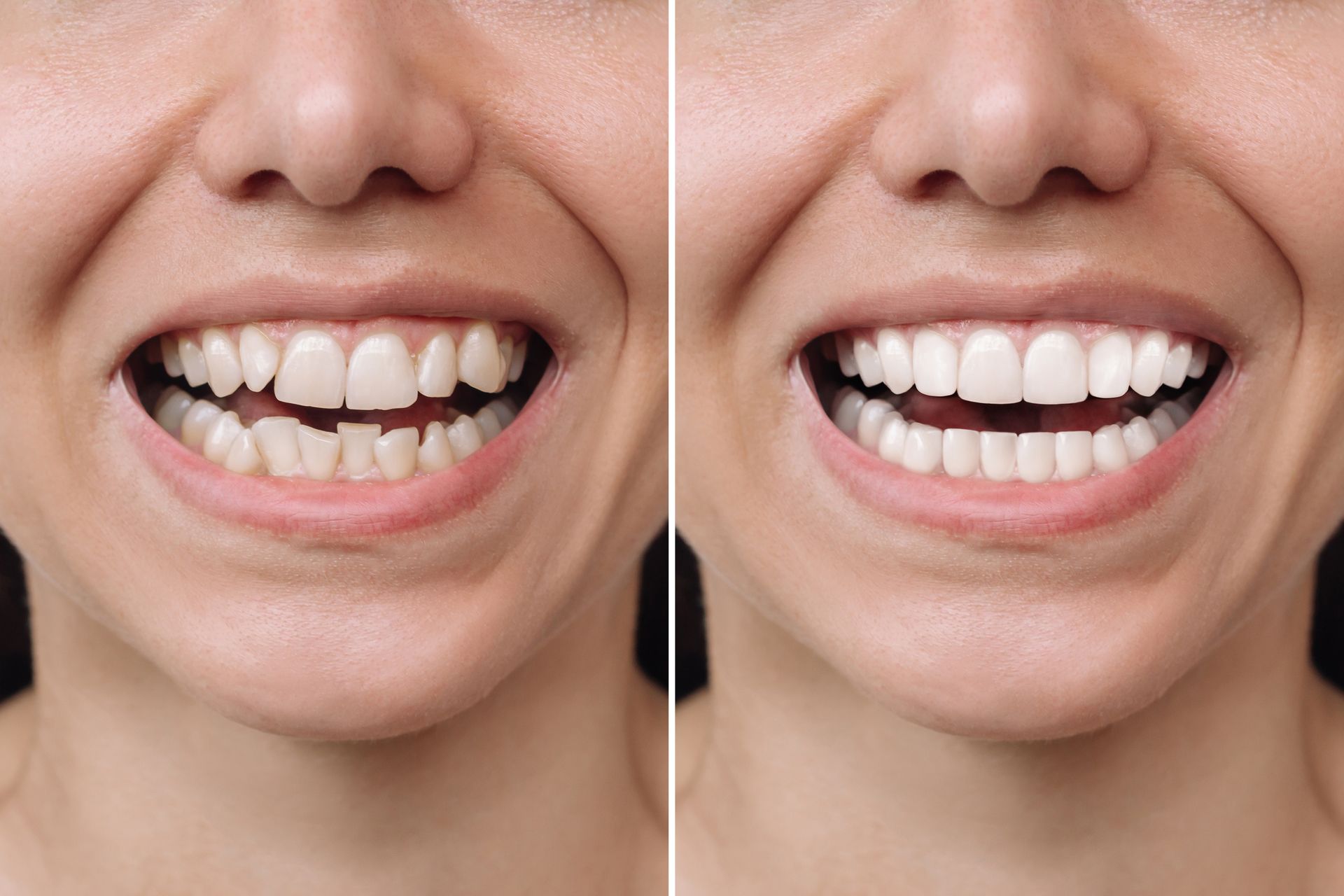 Young woman smiling before and after veneers treatment showing correction of uneven teeth clearly.