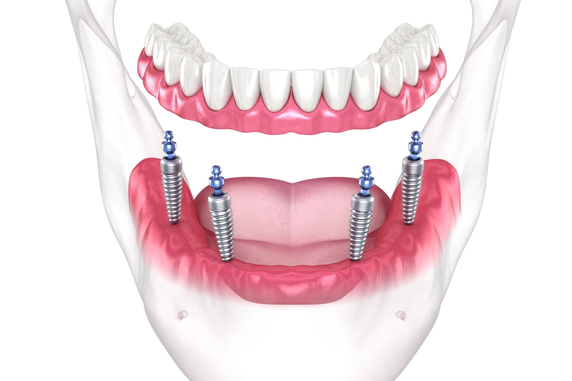 Mandibular removable prosthesis All on four system supported by implants | St. John, IN  