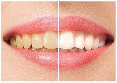 The female teeth before and after whitening — Teeth whitening in Munster, IN