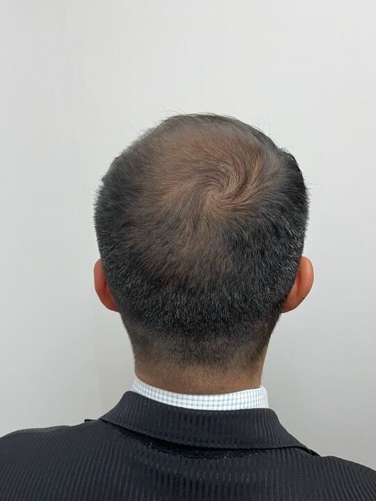 La parte posterior de la cabeza de un hombre con un remolino en ella.