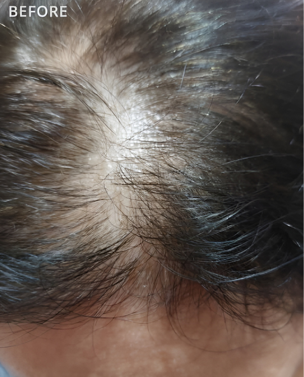 Un primer plano del cabello de una persona antes de un trasplante de cabello.