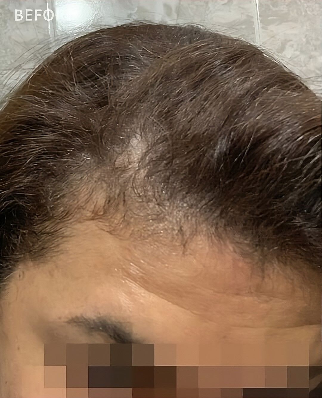 Un primer plano de la cabeza de una mujer con una calva.