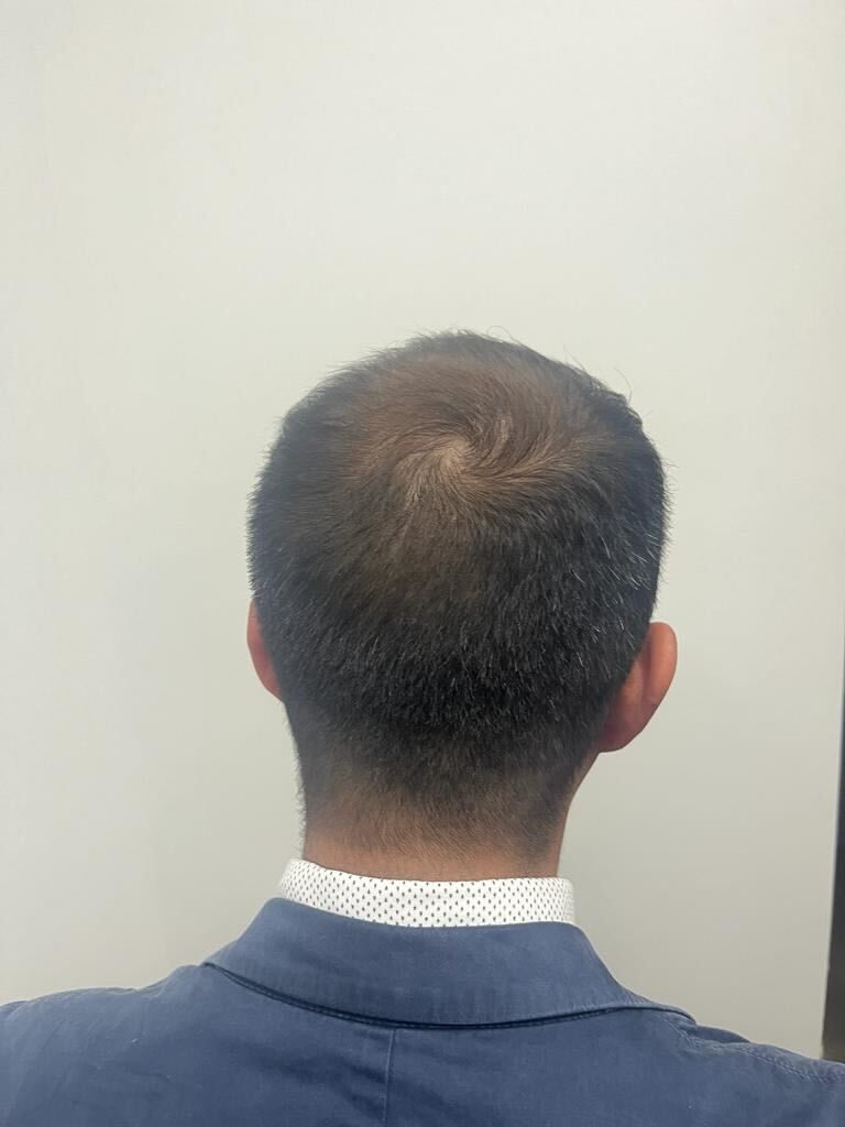 La parte posterior de la cabeza de un hombre con un corte de pelo muy corto.