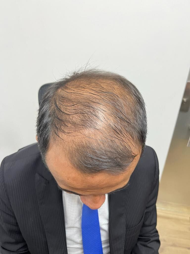 Un hombre con traje y corbata mira hacia su cabeza calva.