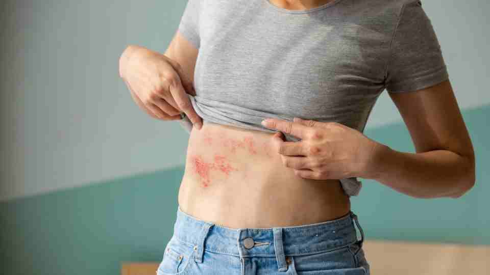 shingles treatment in manchester
