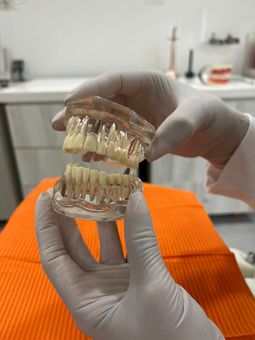 Manos enguantadas sosteniendo un modelo dental transparente con dientes artificiales en un entorno clínico.
