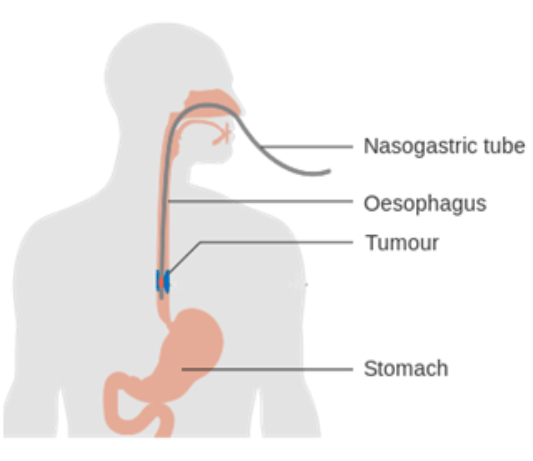 A photo showing the  oesophagus with tumour