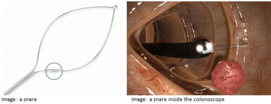 A photo of a snare inside the colonoscope