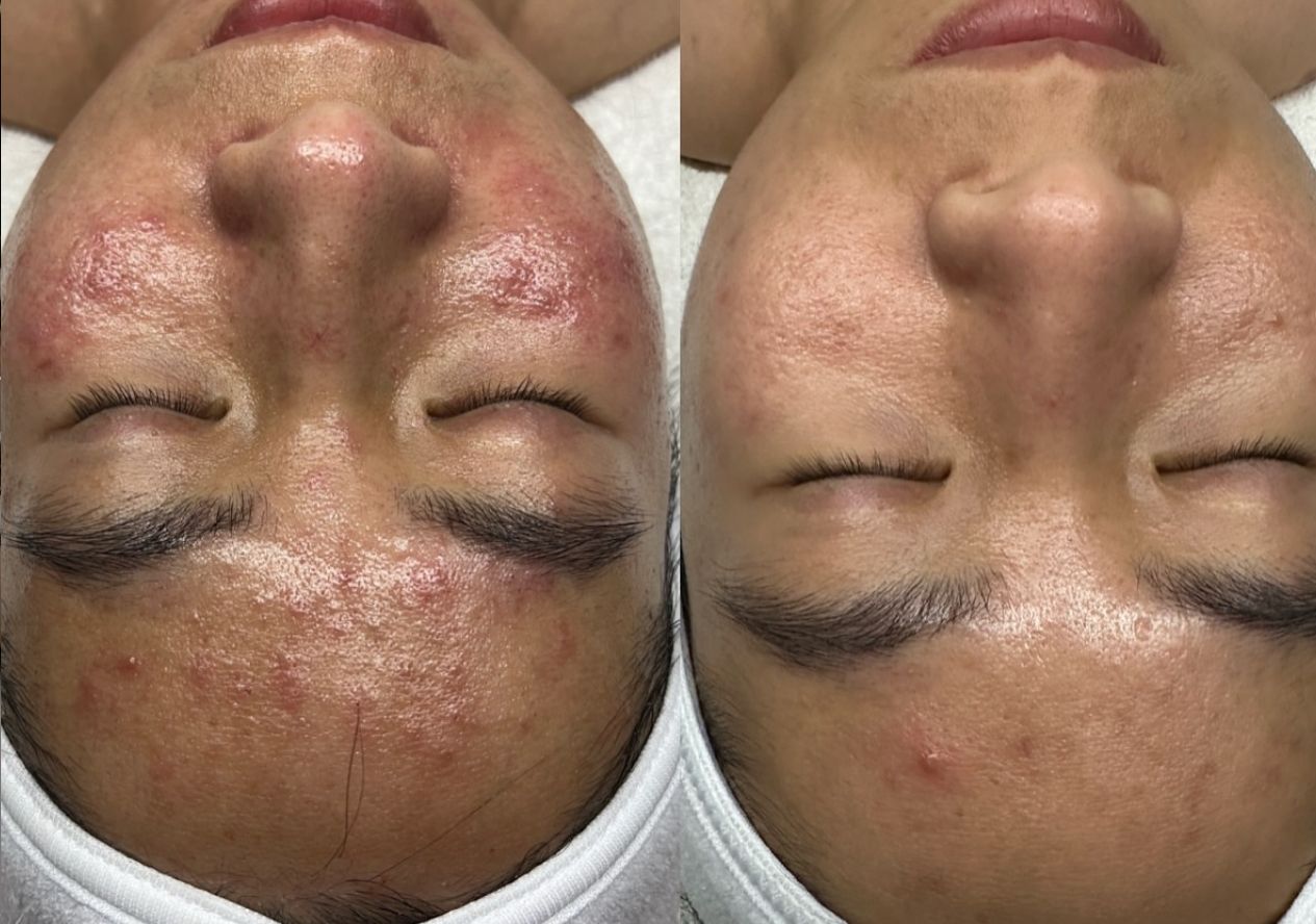 acne client before and after in Columbus Ohio at Future you skin