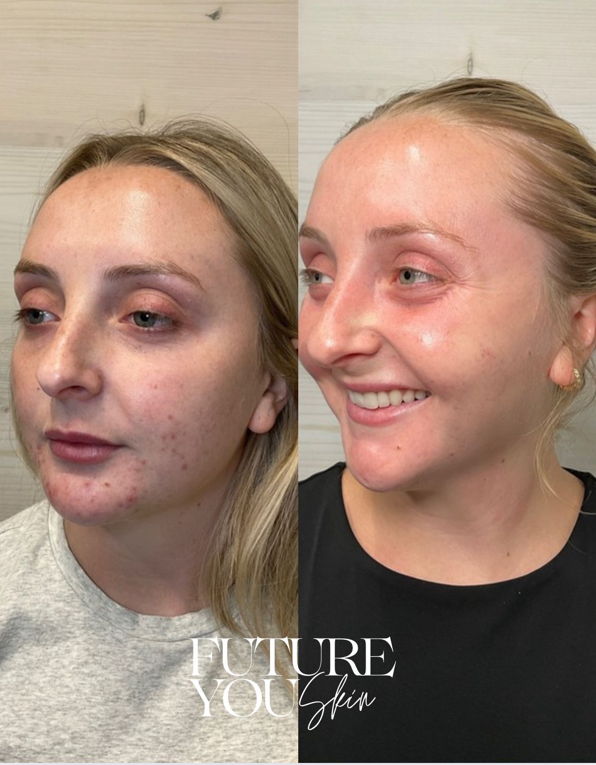 Discover how often you should really get a facial for clear, glowing, healthy skin. Learn the best treatment schedule for acne, anti-aging, and maintenance + book your customized facial at Future You Skin in Gahanna, Ohio.