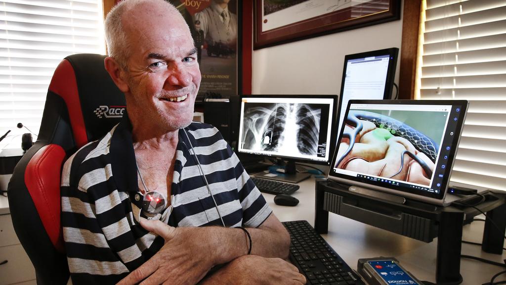Phil O'Keefe Stentrode implant patient