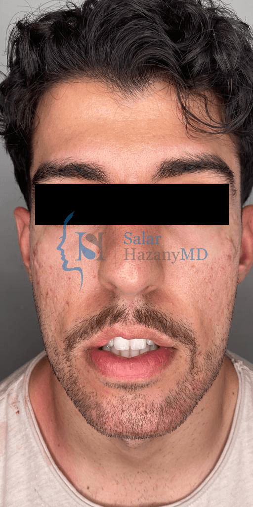 Front profile of person after acne scar treatment. Acne Scars are virtually gone.