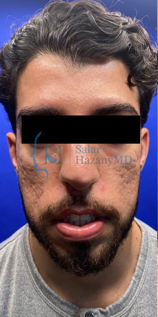 Front profile of person with acne scars before treatment