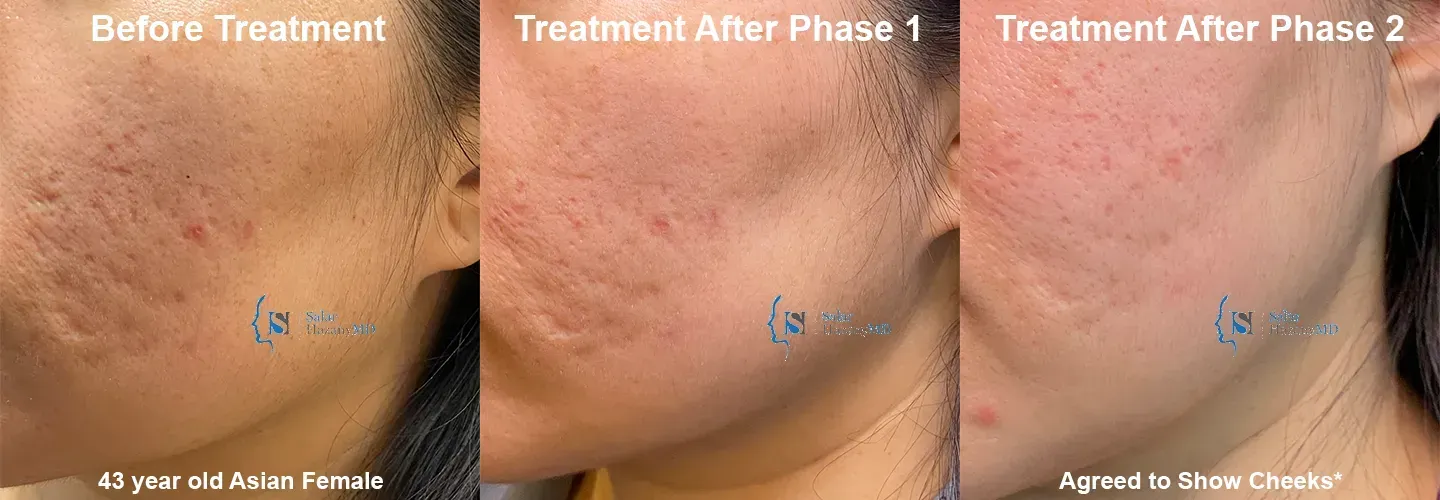 A woman 's face is shown before and after treatment.