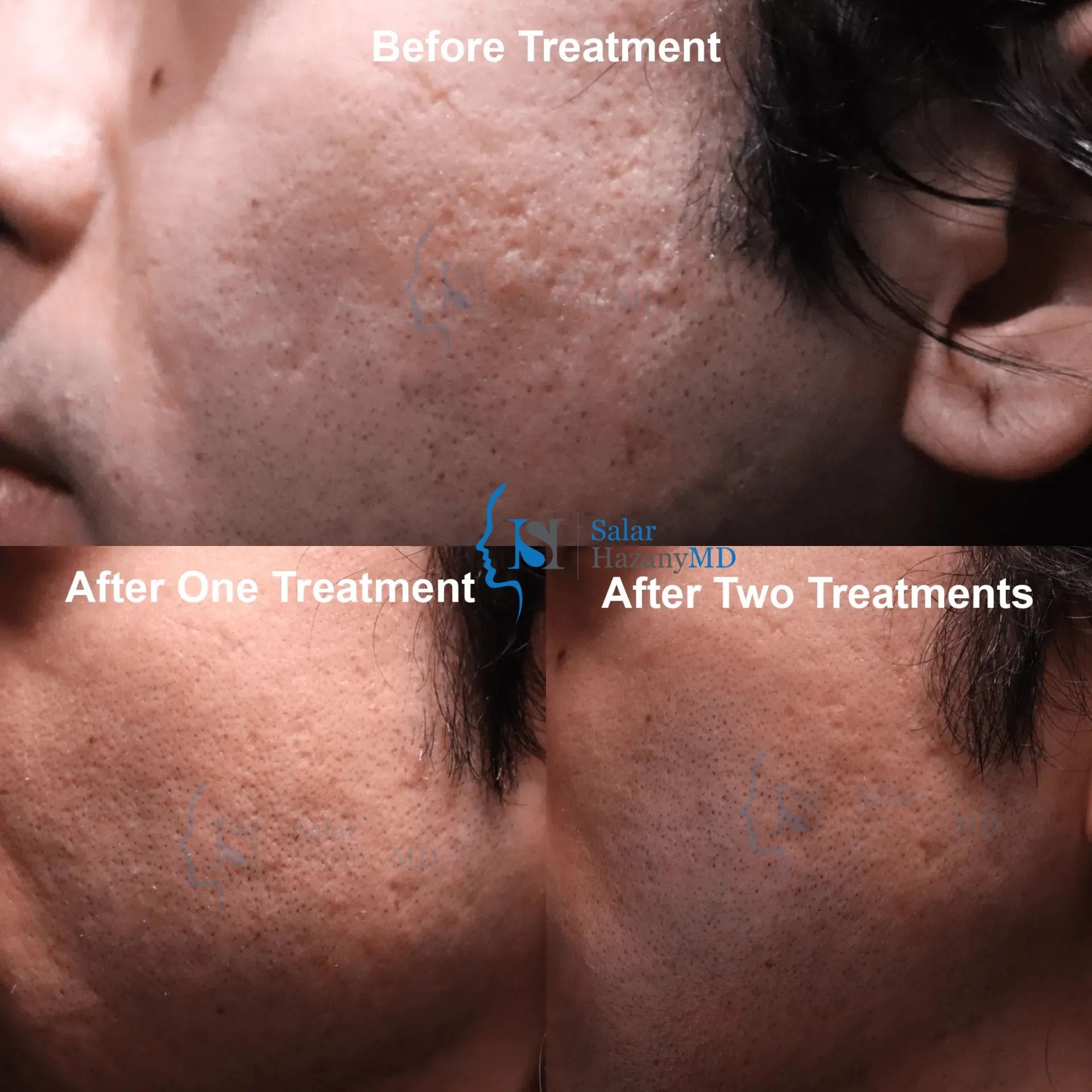A woman 's face is shown before and after treatment.