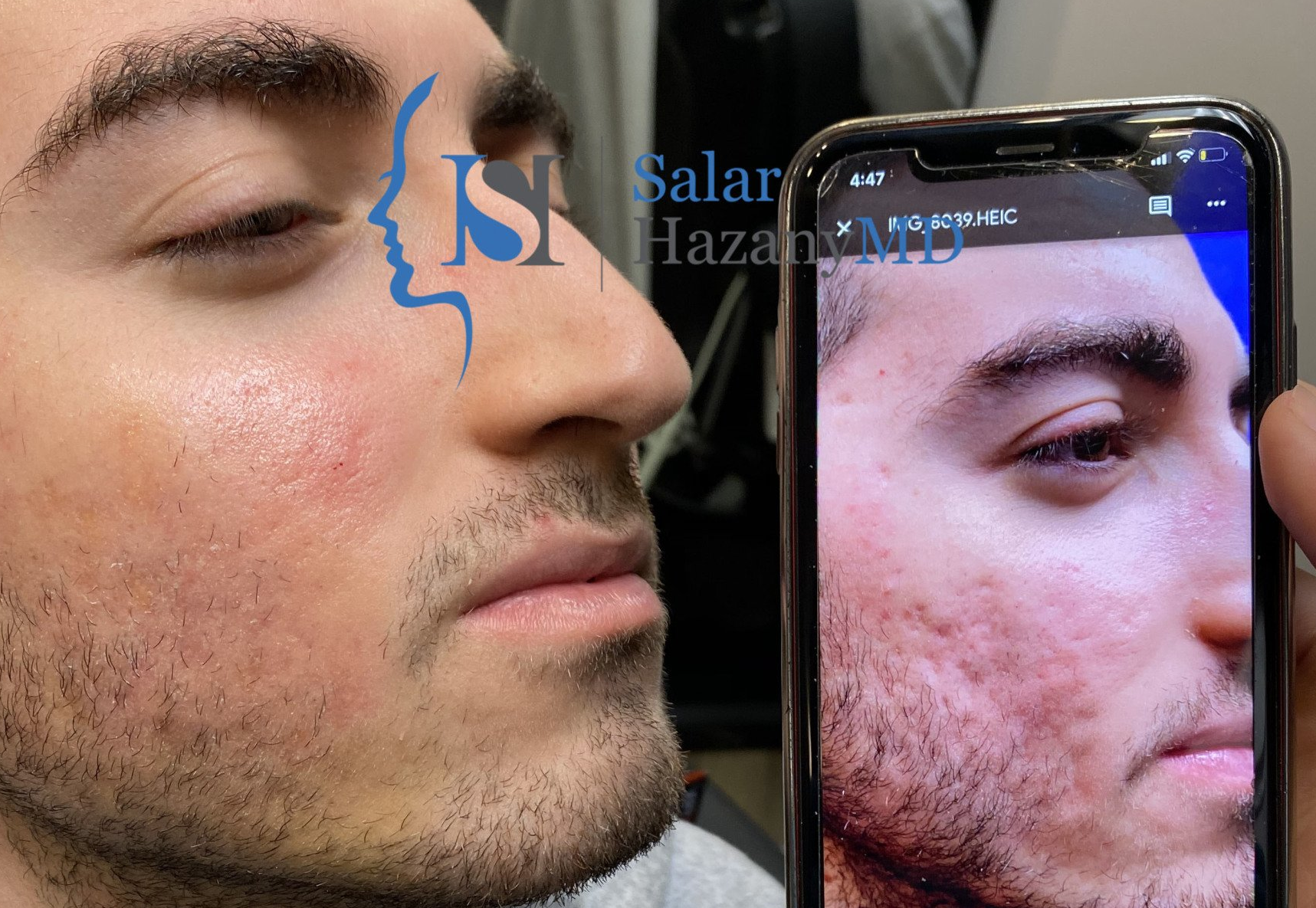 Before/After Image of Acne Scar Treatment Near the San Fernando Valley
