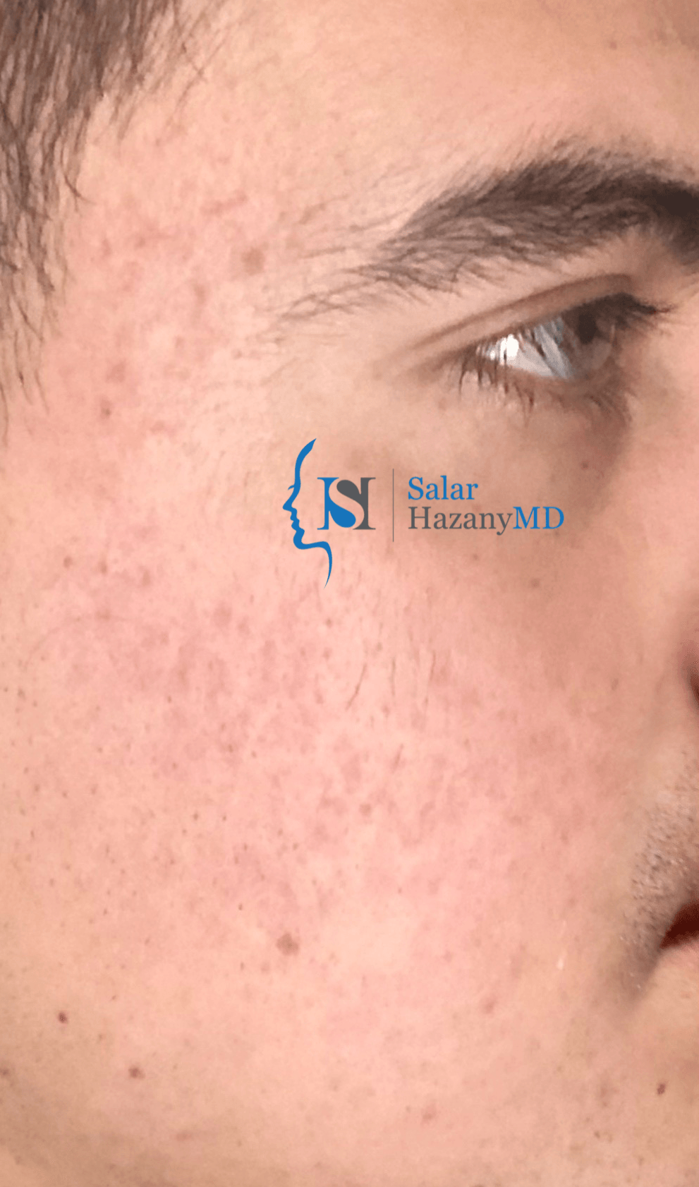 Looking for the World's Best Acne + Acne Scar Doctor?