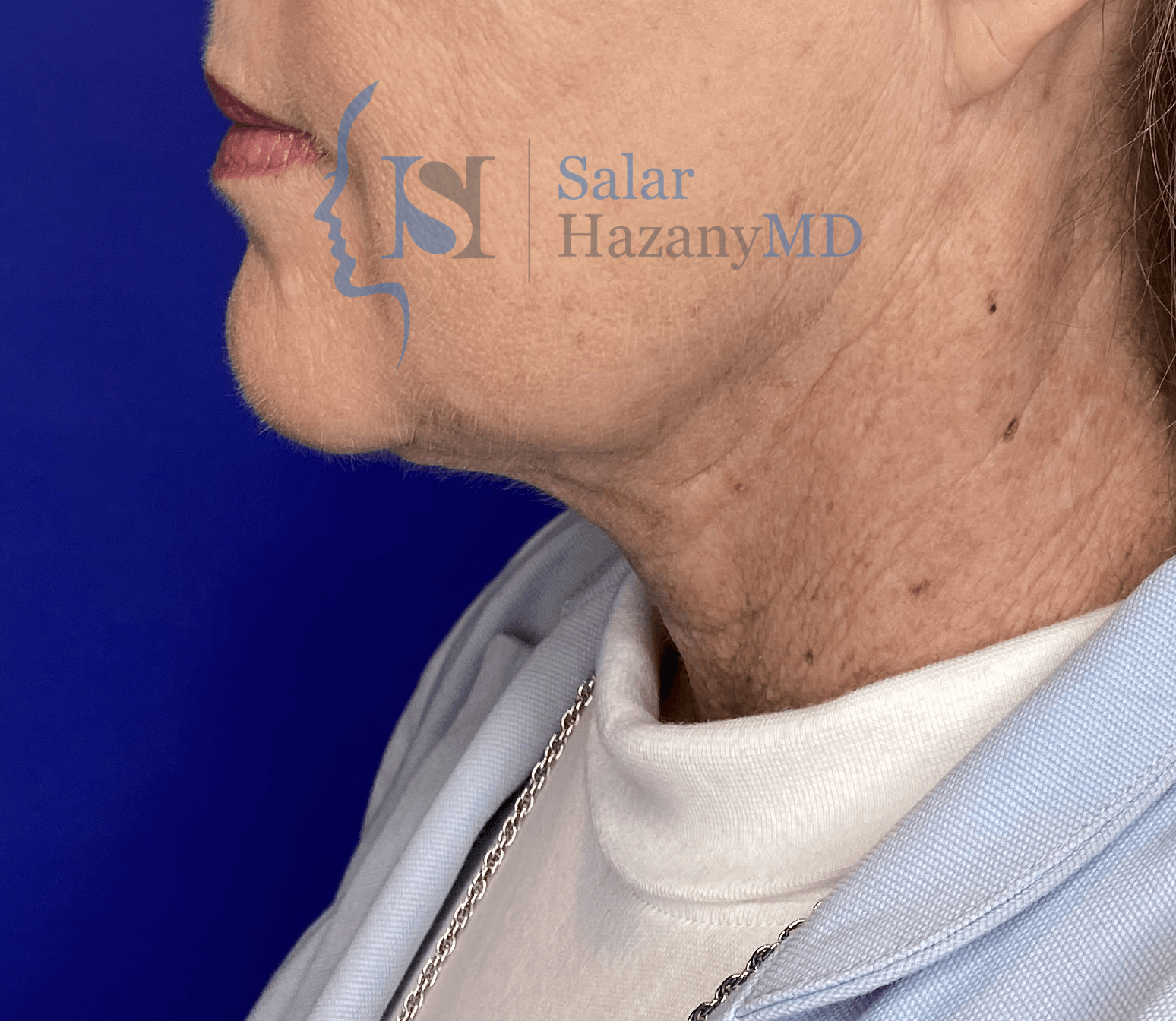 Image after neck lift surgery in LA - Woman with tighter, younger looking neck
