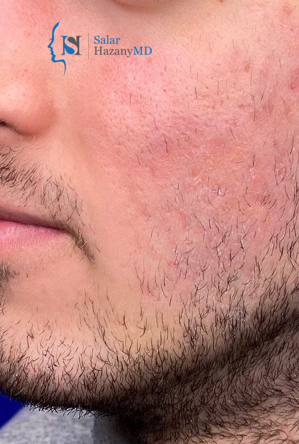 Looking for the World's Best Acne + Acne Scar Doctor?