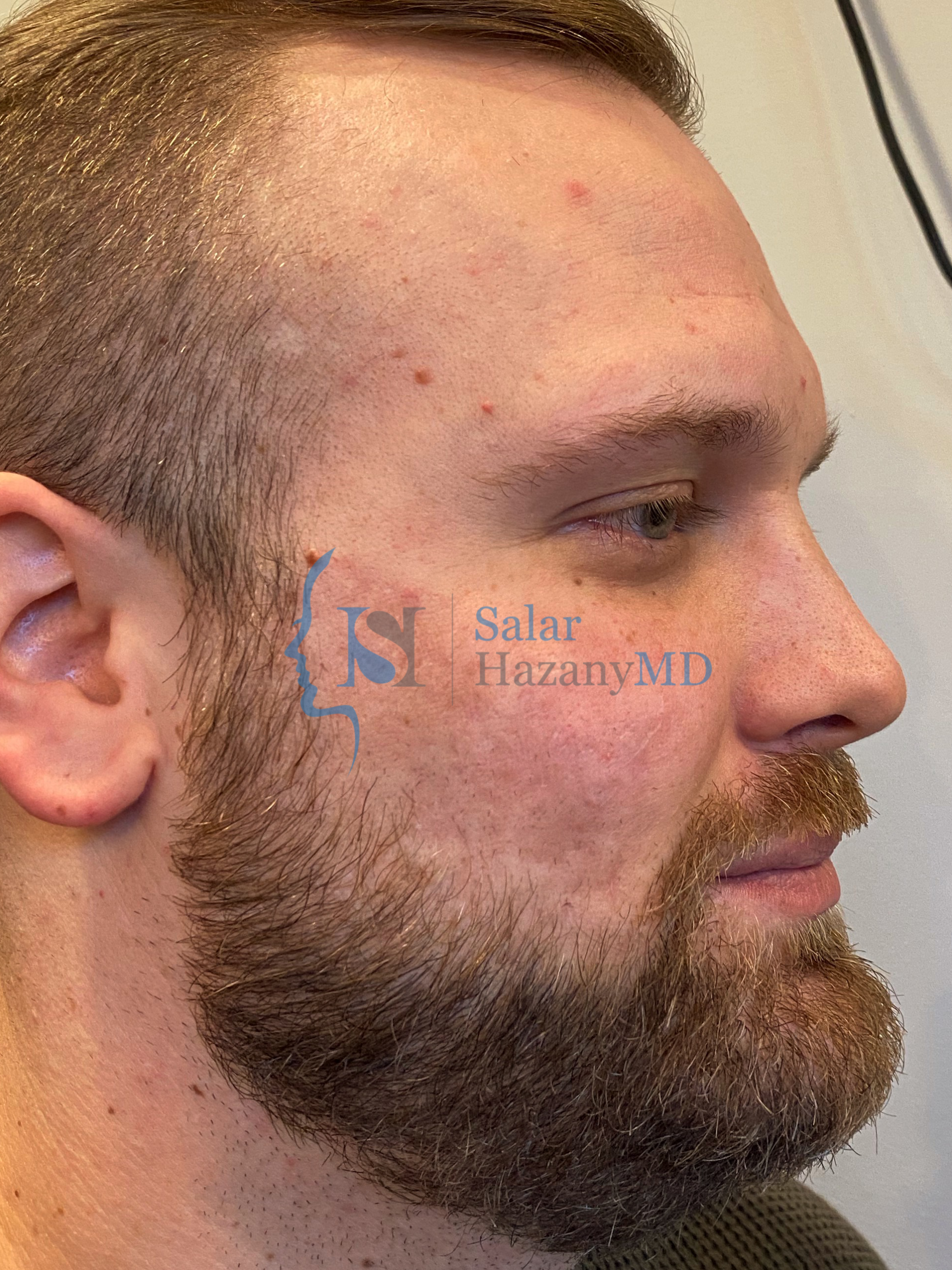 Side profile of bearded person after acne scar treatment