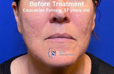 A woman is shown before treatment for caucasian female , 57 years old.