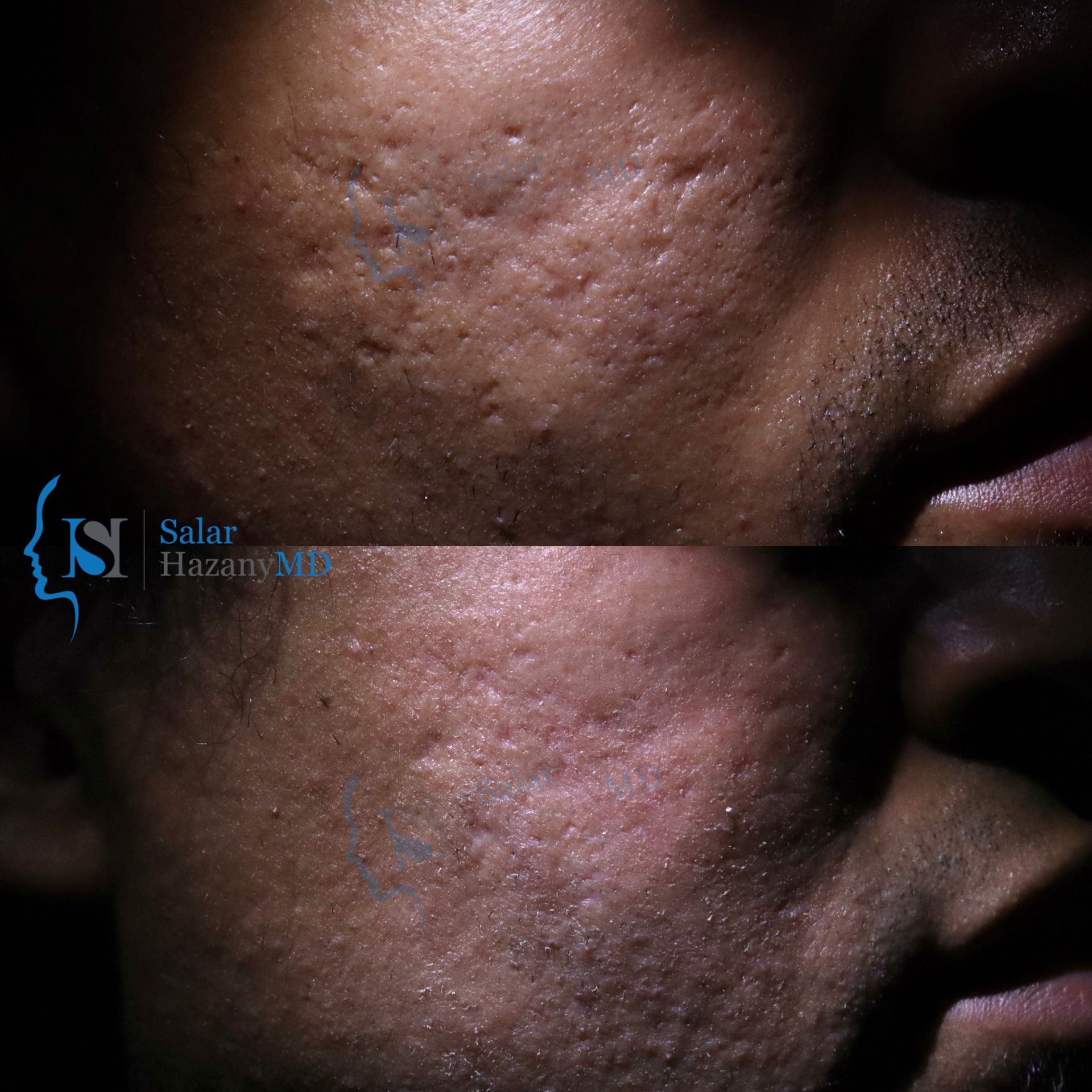 A woman 's face is shown before and after treatment.
