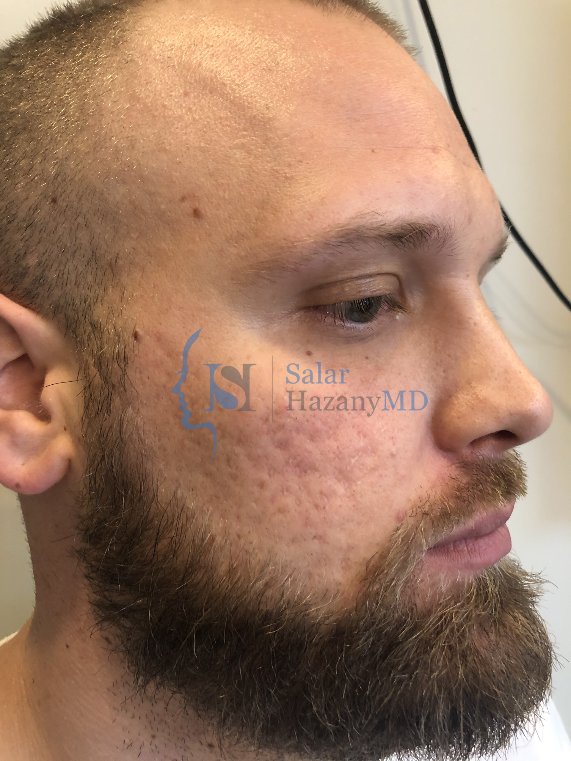 Side profile of bearded person with acne scars