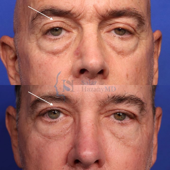 A before and after photo of a man 's face with arrows pointing to his eyebrows.