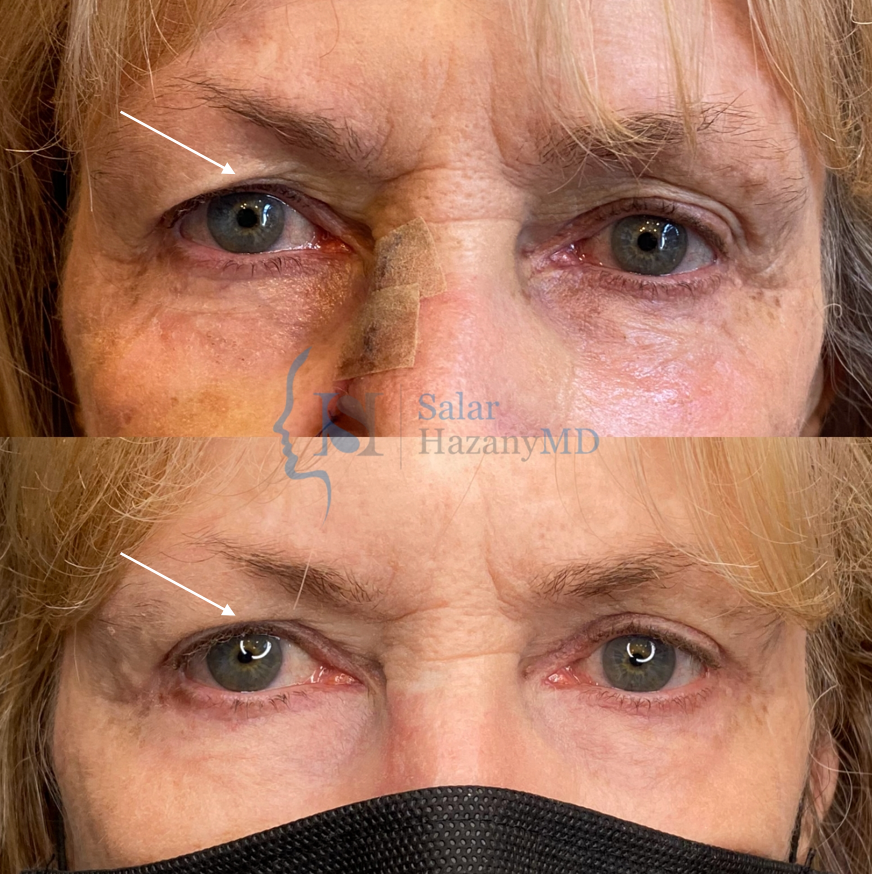 A before and after photo of a woman wearing a mask.