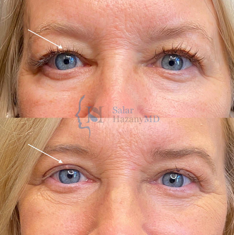 A before and after photo of a woman 's eyebrows.