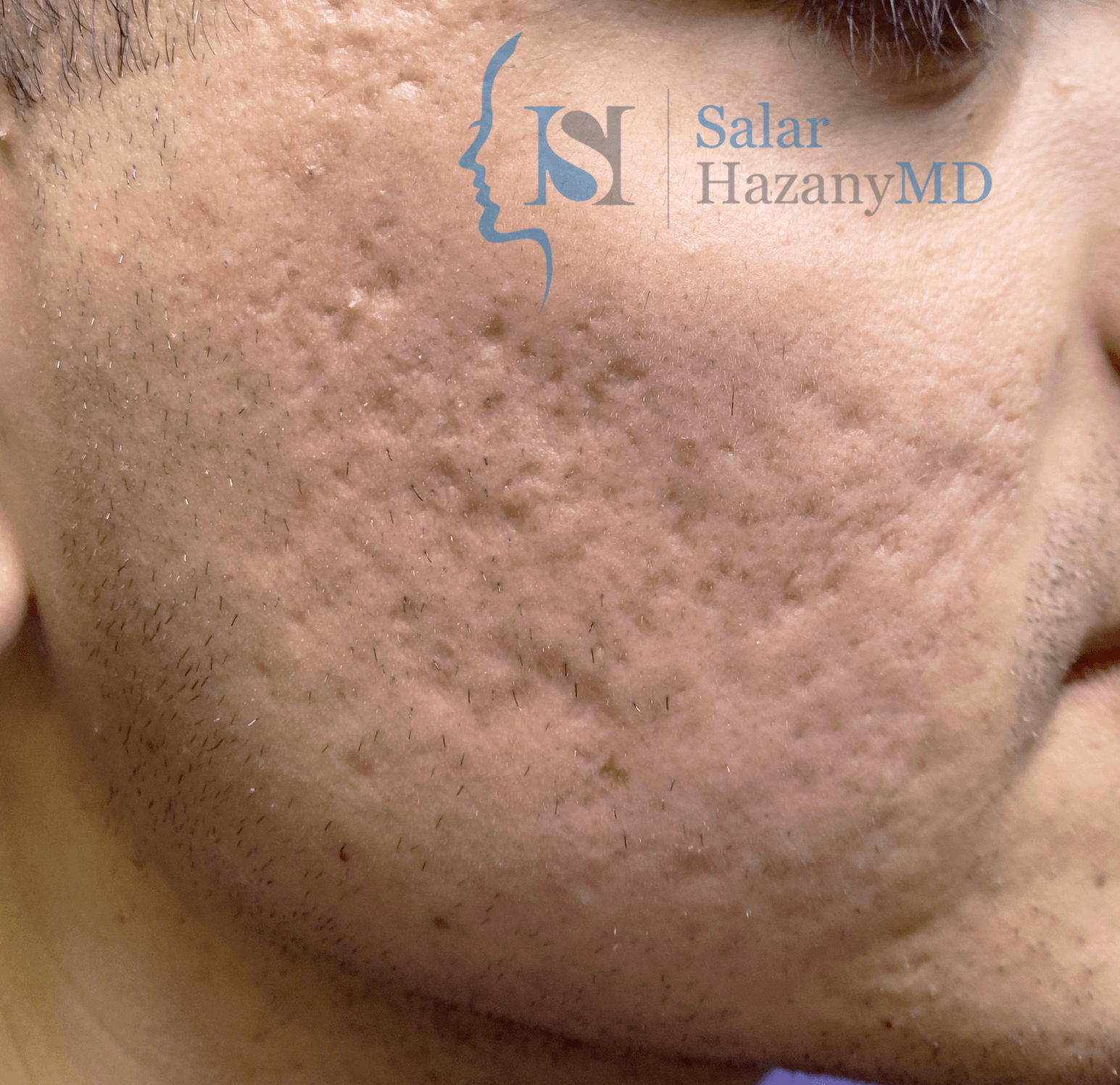 Image of Rolling and Box Car Acne Scars in Beverly Hills Dermatology Clinic