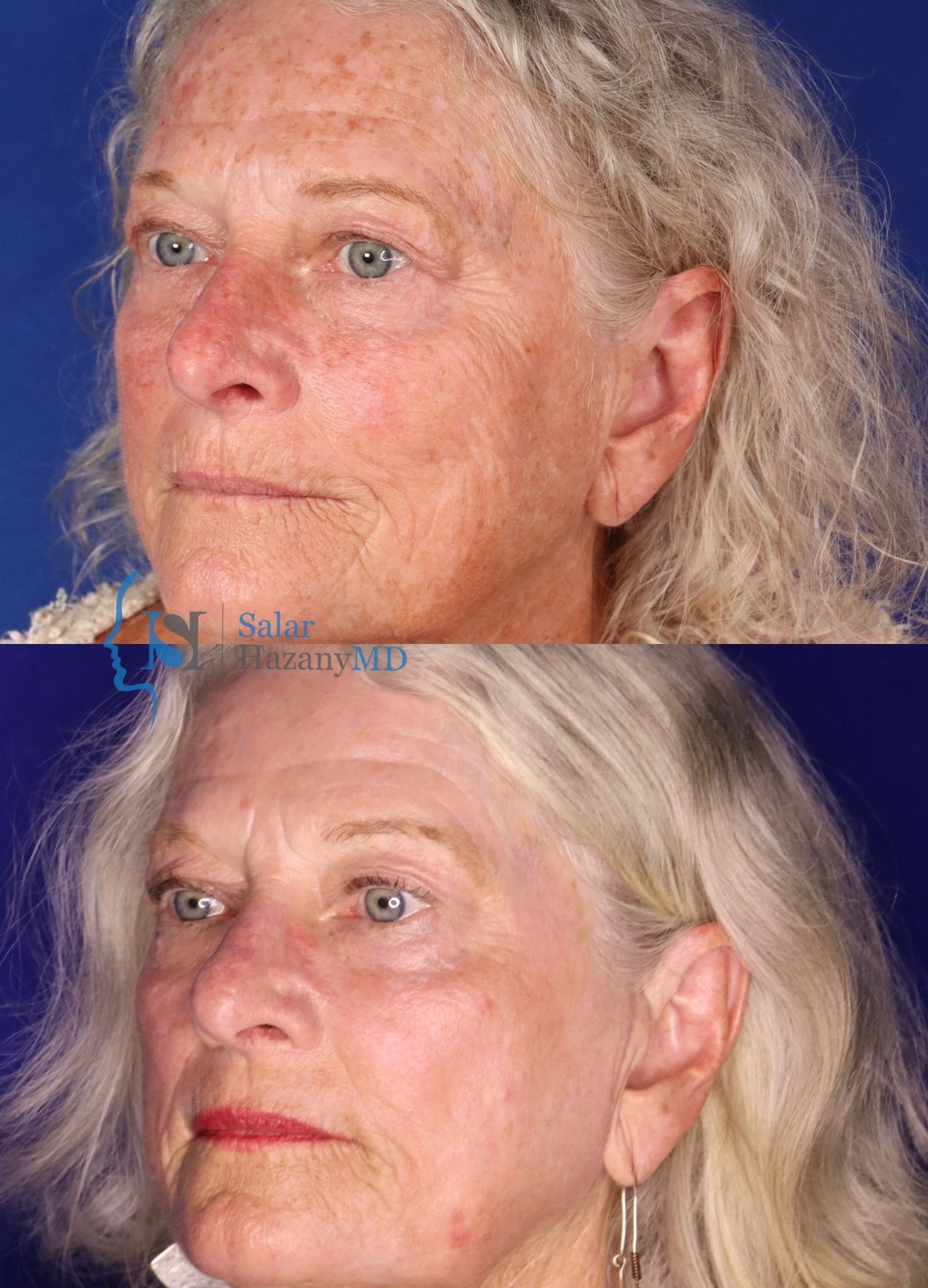 A before and after picture of a man 's neck