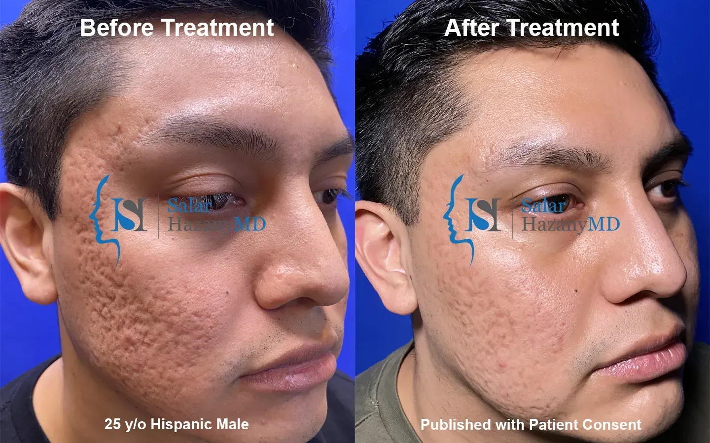 A woman 's face is shown before and after treatment.
