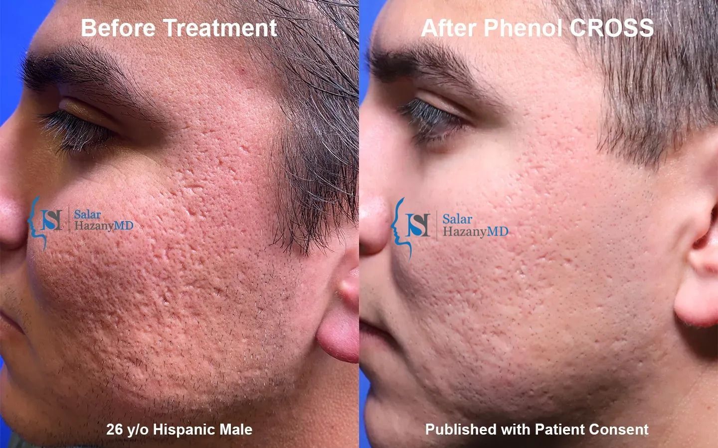 A woman 's face is shown before and after treatment.