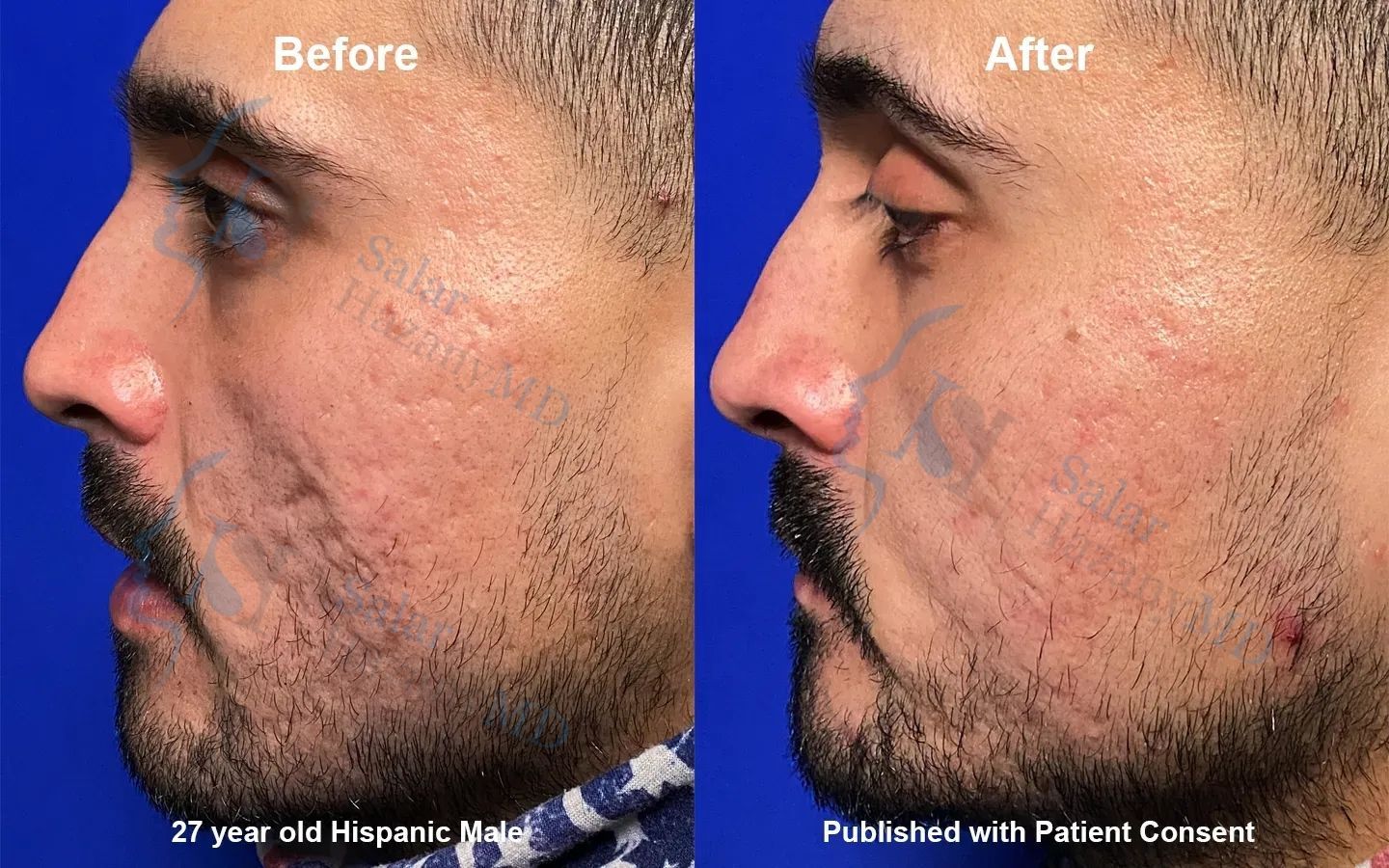 A before and after photo of a woman 's face with acne.