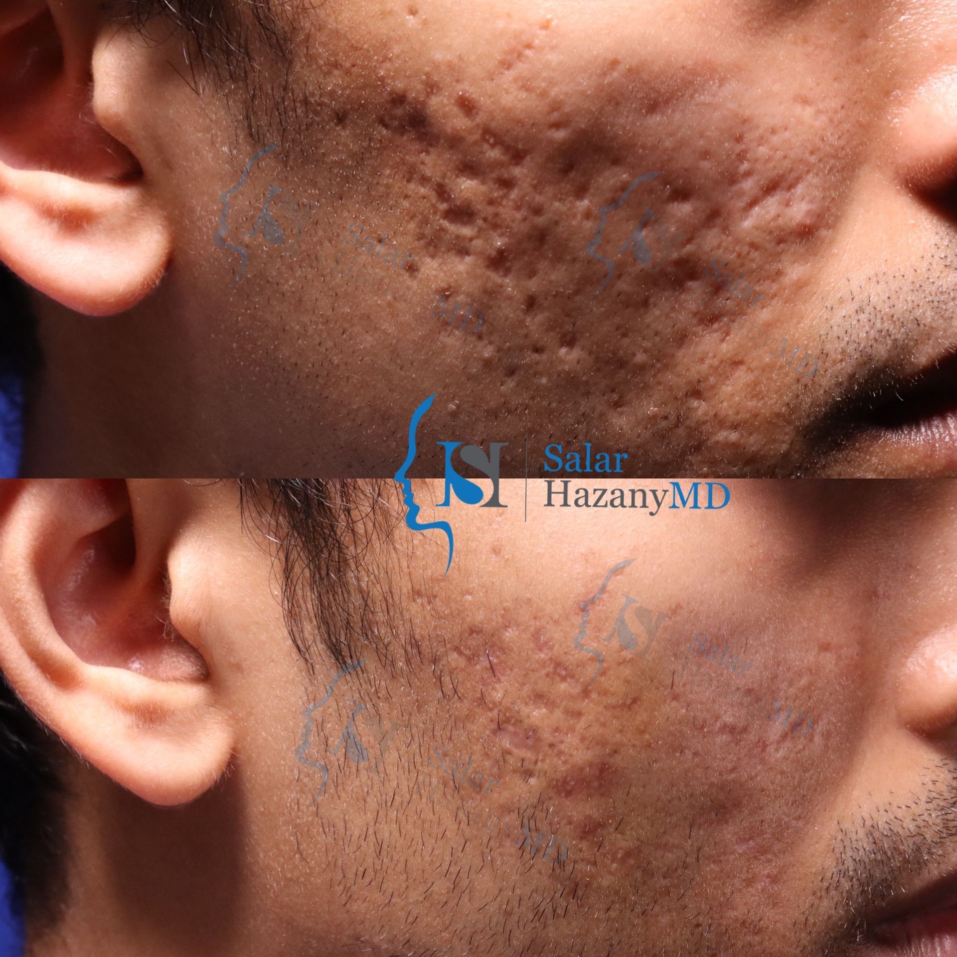 A woman 's face is shown before and after treatment.
