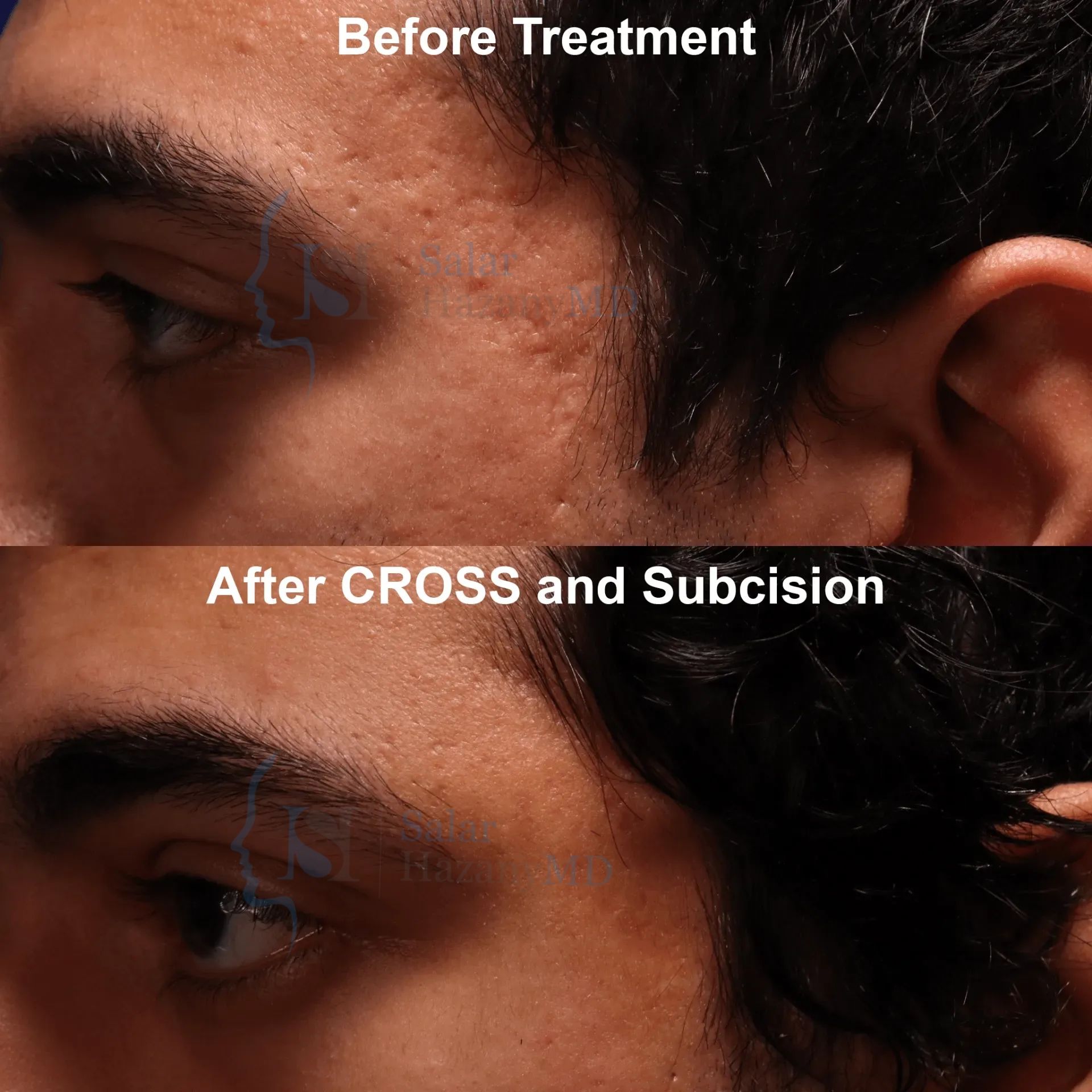 A woman 's face is shown before and after treatment.