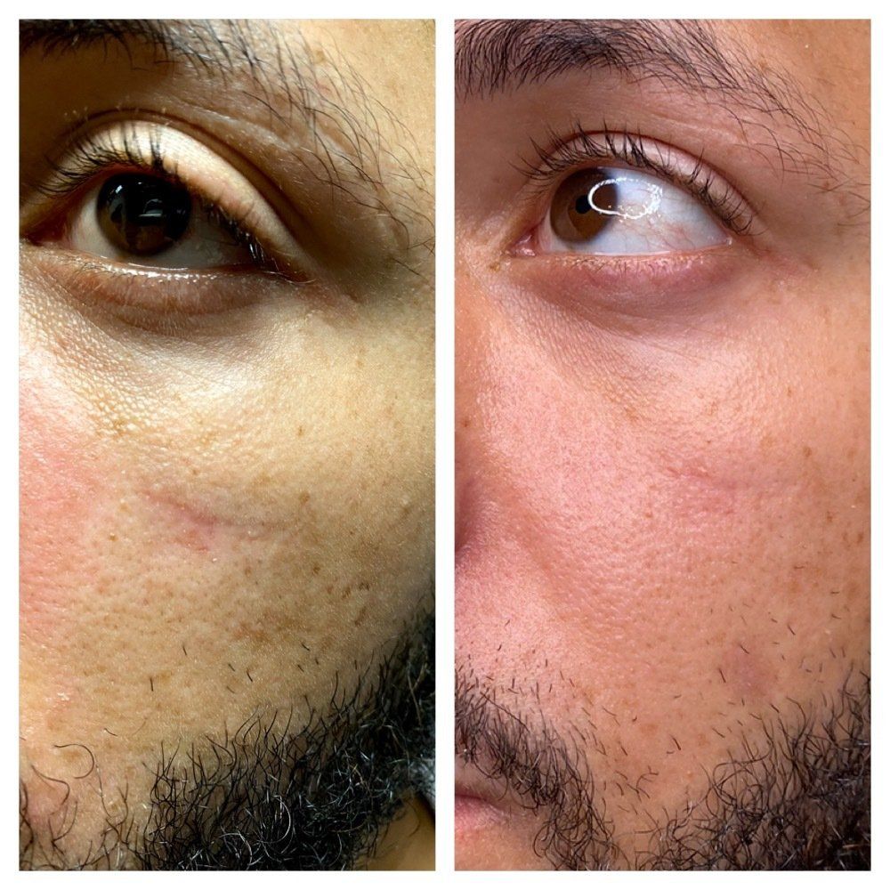 Acne Scar Treatment for Black Skin Los Angeles