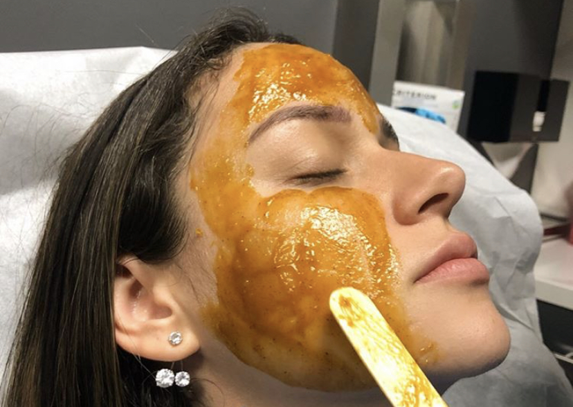 Image of Chemical Peel Application for Acne Treatment