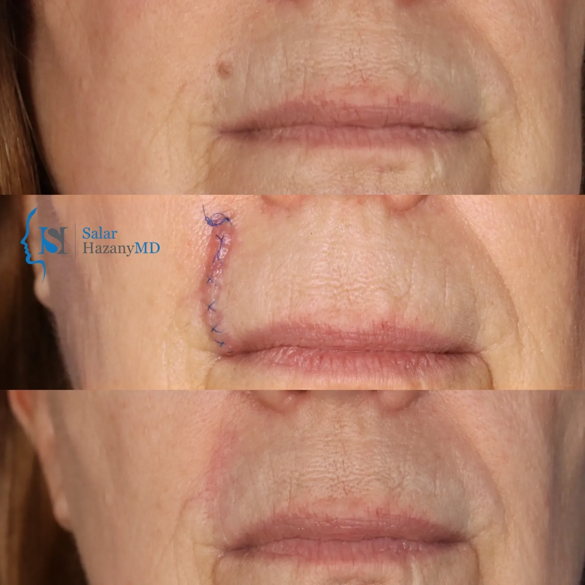 A close up of a person 's skin with the name salar hazany md on the bottom