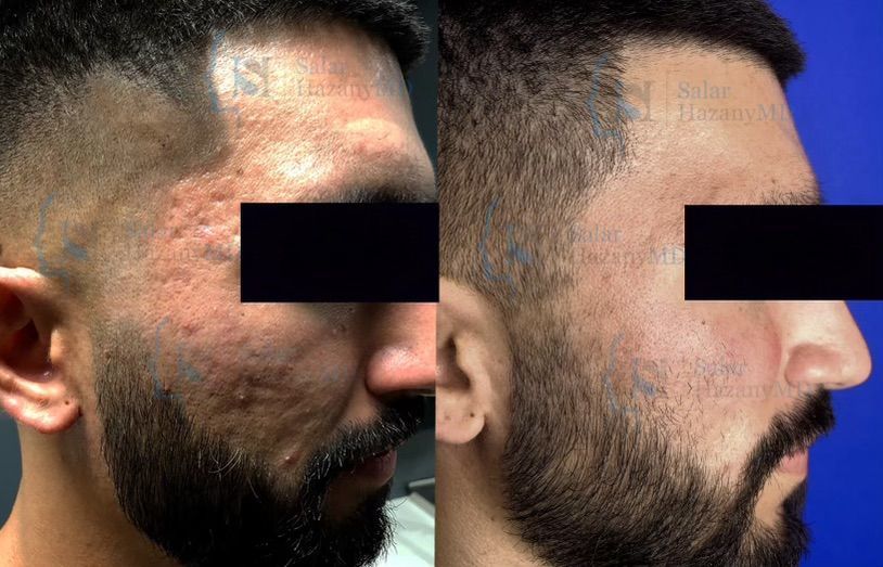 A woman 's face is shown before and after treatment.