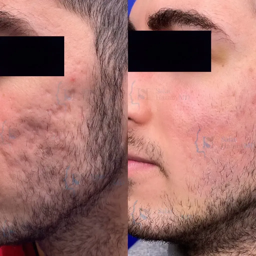 A woman 's face is shown before and after treatment.