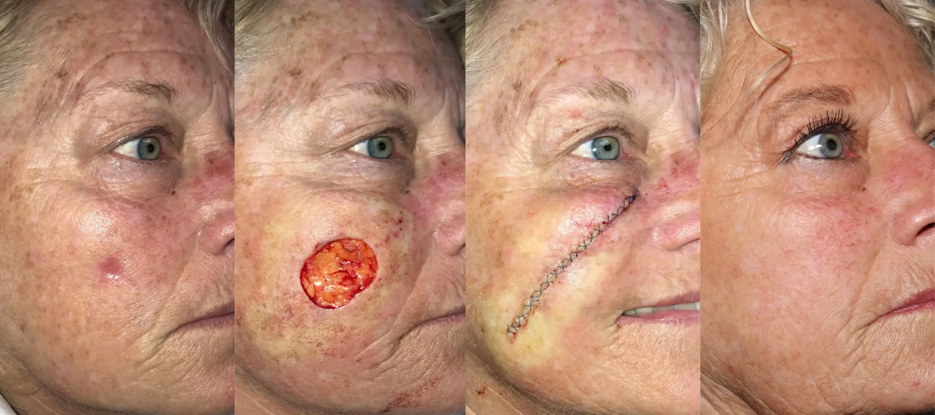 A man with a beard and scars on his face before and after surgical revision.