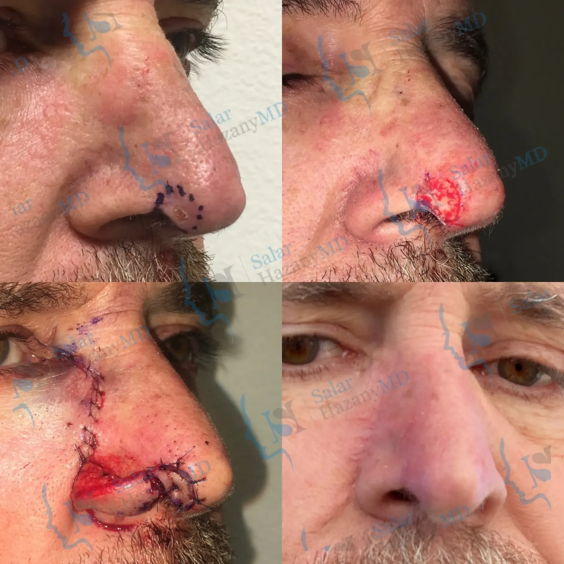 A close up of a person 's skin with the name salar hazany md on the bottom