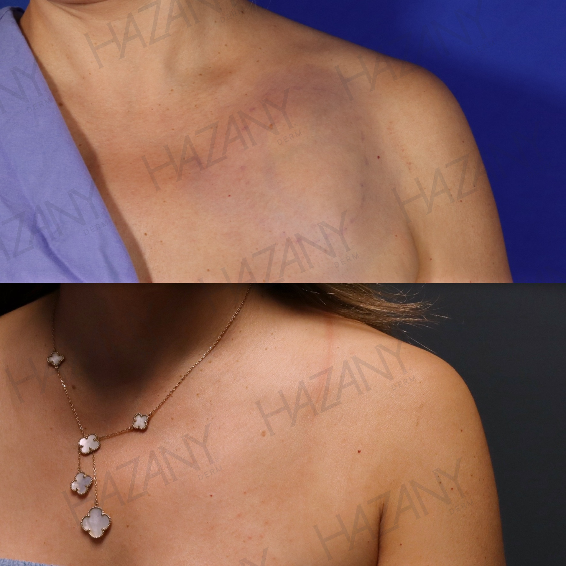 Comparison of a shoulder before and after a procedure. The after photo shows a smoother appearance.