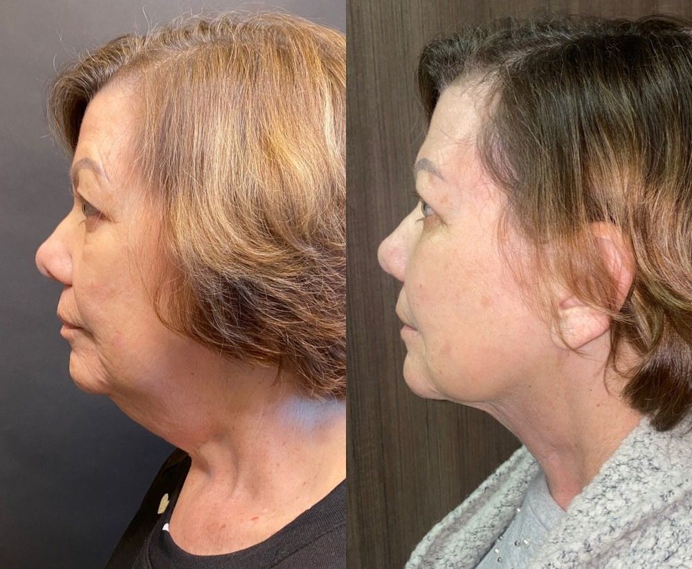 A before and after photo of a woman 's neck and face.